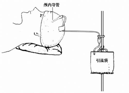 脑室引流1.jpg